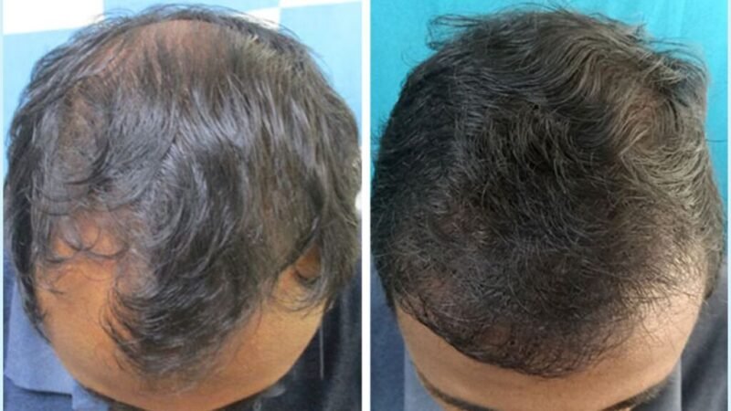 VCare’s Hair Transplantation Ensures To Completely Reverse Baldness